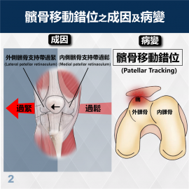 Medex K17 - Horseshoe-buttress Patello-Femoral Brace (Universal) 馬蹬式髕骨矯形護托