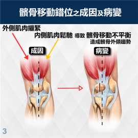 Medex K17 - Horseshoe-buttress Patello-Femoral Brace (Universal) 馬蹬式髕骨矯形護托